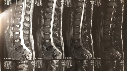 Why I Haven’t Worked in Four Months (And Why I’m Getting Back Surgery)